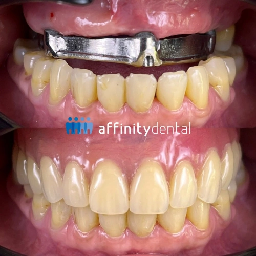 Before-and-after photos showing an upper implant-supported denture case with metal framework and final prosthesis at Affinity Dental Clinics