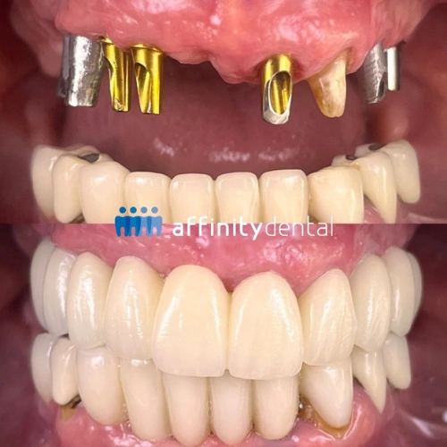 Before-and-after photos showing abutments and final prosthesis of an upper implant-supported dental bridge at Affinity Dental Clinics
