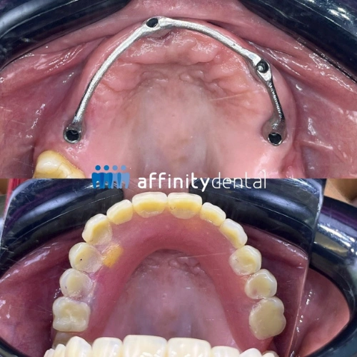 Clinical photos showing the bar framework and final prosthesis of an upper implant-supported denture at Affinity Dental Clinics