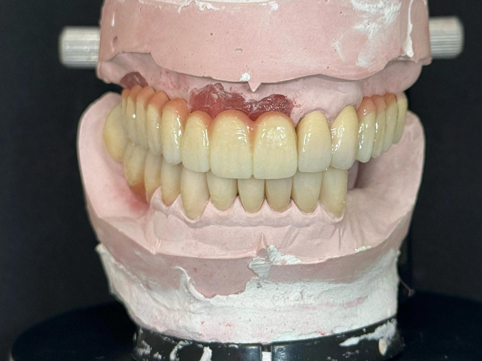 Model of an implant-supported zirconia dental bridge and zirconia crowns crafted at Affinity Dental Clinics’ in-house dental laboratory.