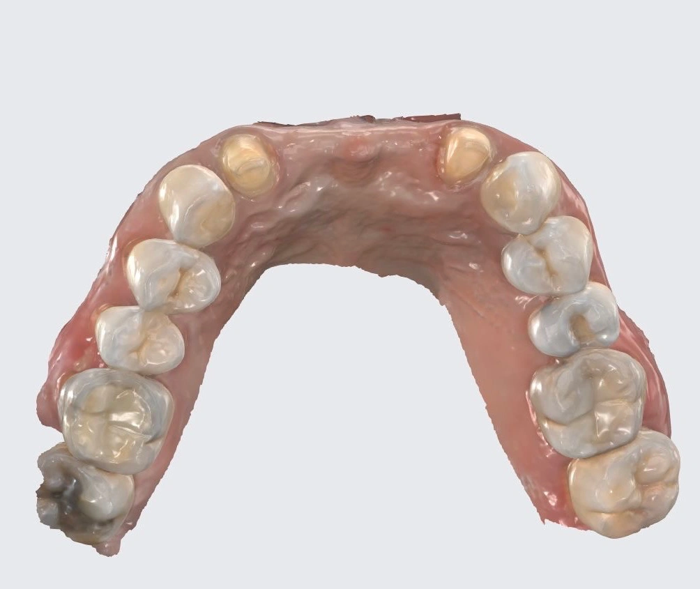 Digital intraoral scan of upper teeth prepared for crowns at Affinity Dental Clinics’ dental laboratory.