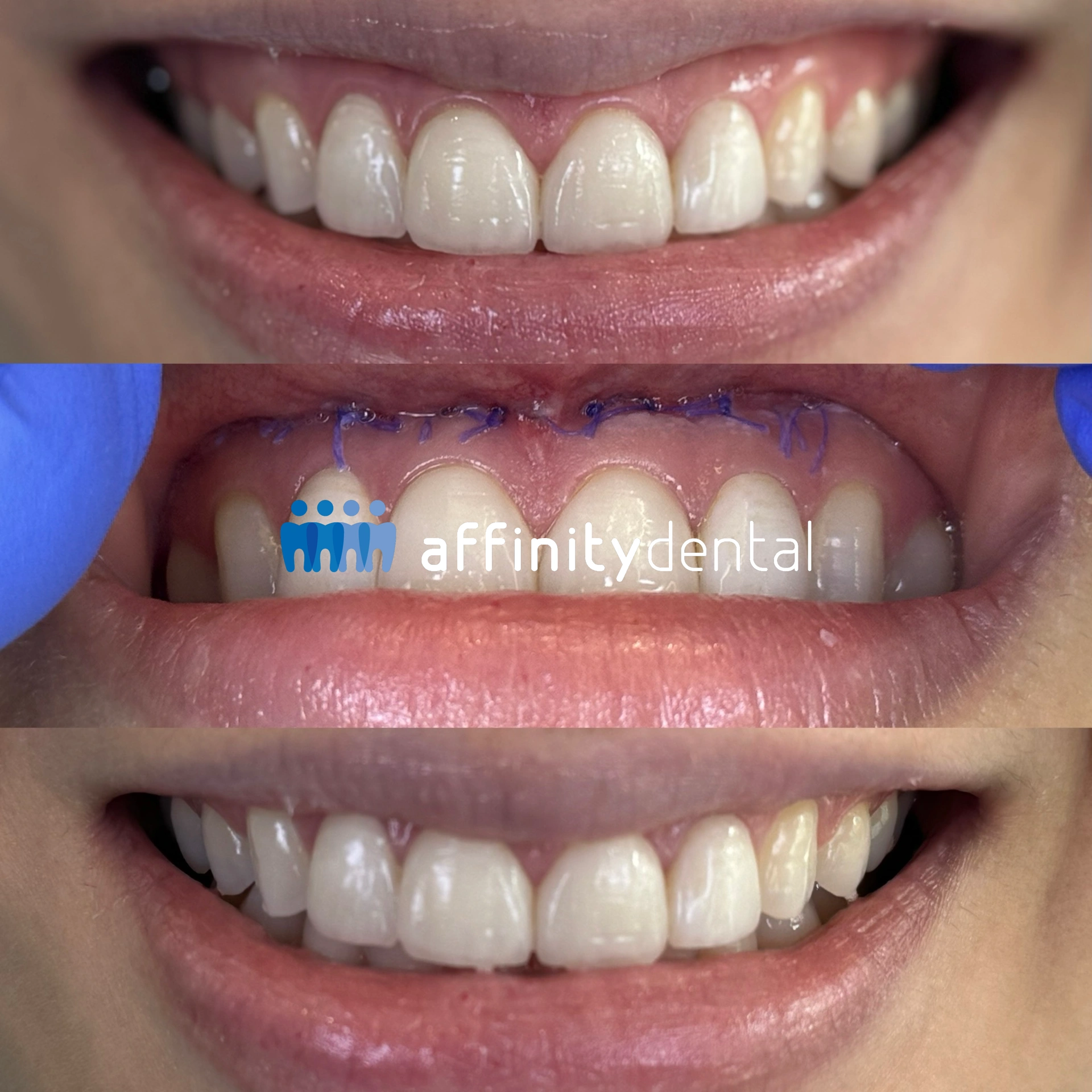 Before, during, and after photos of a patient’s smile showing the results of lip repositioning surgery at Affinity Dental Clinics Makati to reduce excessive gum display.