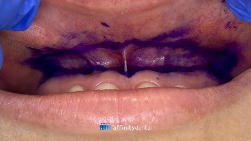 Clinical close-up showing purple surgical markings on the upper inner lip for lip repositioning procedure at Affinity Dental Clinics.