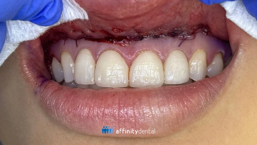Clinical photo showing sutures on the upper inner lip following lip repositioning surgery at Affinity Dental Clinics. Caption: Immediate postoperative view of lip repositioning surgery at Affinity Dental Clinics, showing sutures placed to reduce excessive gum exposure when smiling.