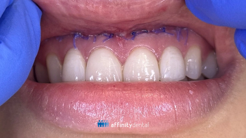 Close-up of a patient’s upper gum and lip with sutures in place during the healing phase after lip repositioning surgery at Affinity Dental Clinics.