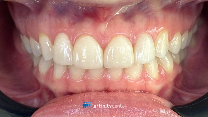 Close-up of a patient’s teeth and gums showing improved smile aesthetics after complete healing from lip repositioning surgery at Affinity Dental Clinics.