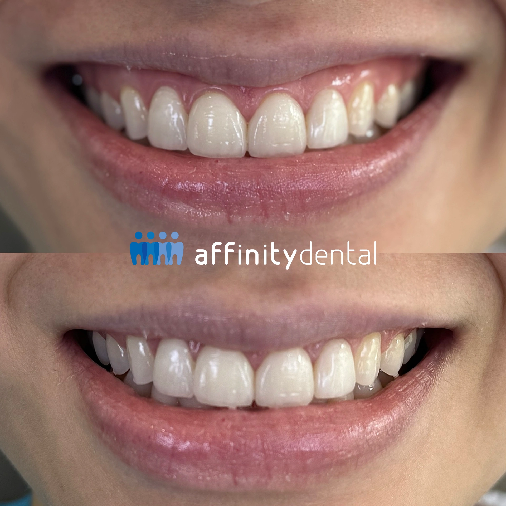 Before-and-after comparison of a patient’s smile showing reduced gum display after lip repositioning surgery at Affinity Dental Clinics.