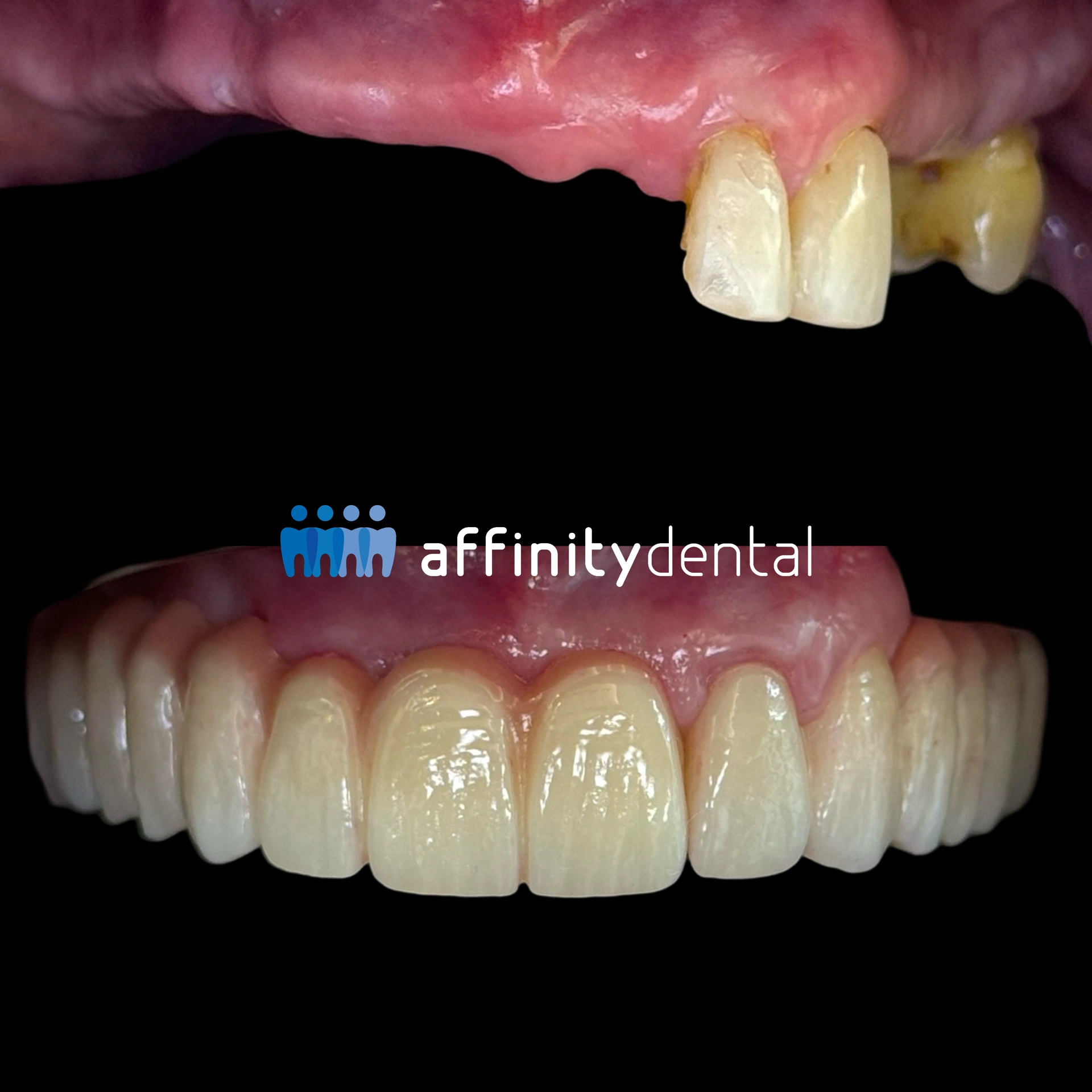 Before and after photo of full-arch zirconia implant fixed bridge by at Affinity Dental Clinics.