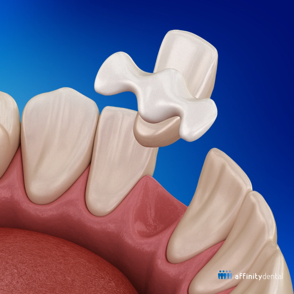 Illustration of a Maryland Bridge dental restoration in the Philippines, showing its attachment to adjacent teeth.