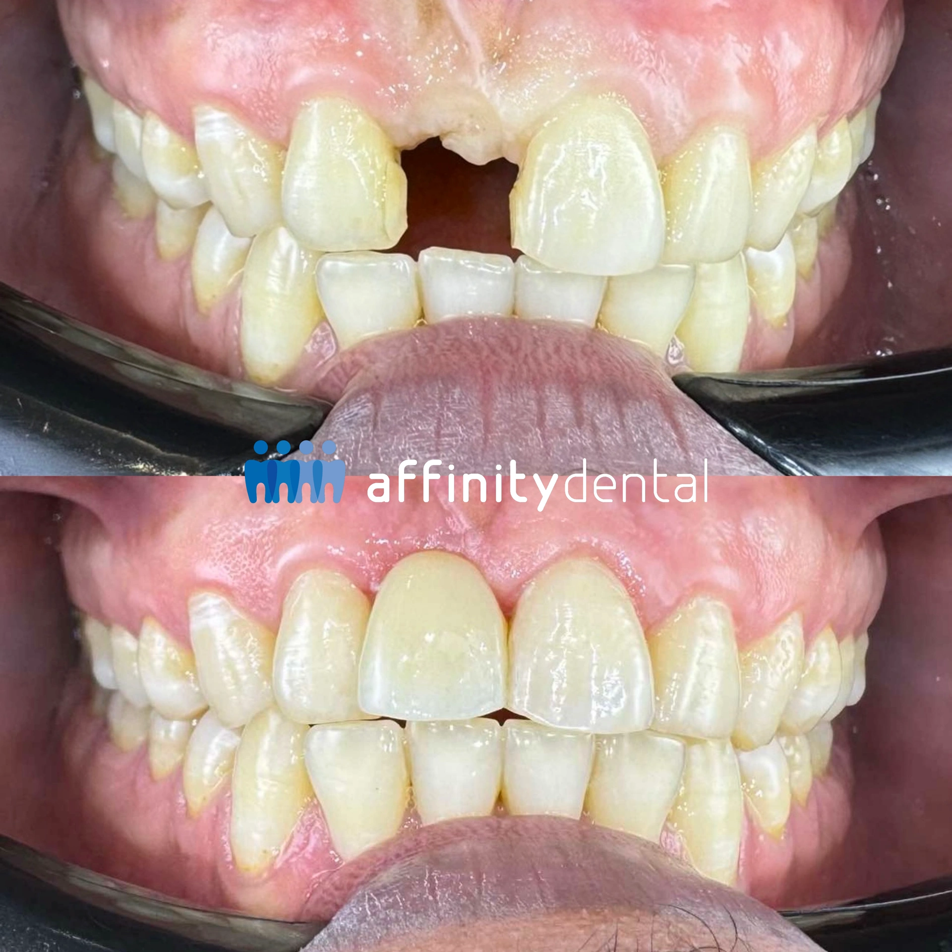 Before-and-after photos showing replacement of a missing front tooth with a Zirconia Maryland Bridge at Affinity Dental Clinics BGC Stopover