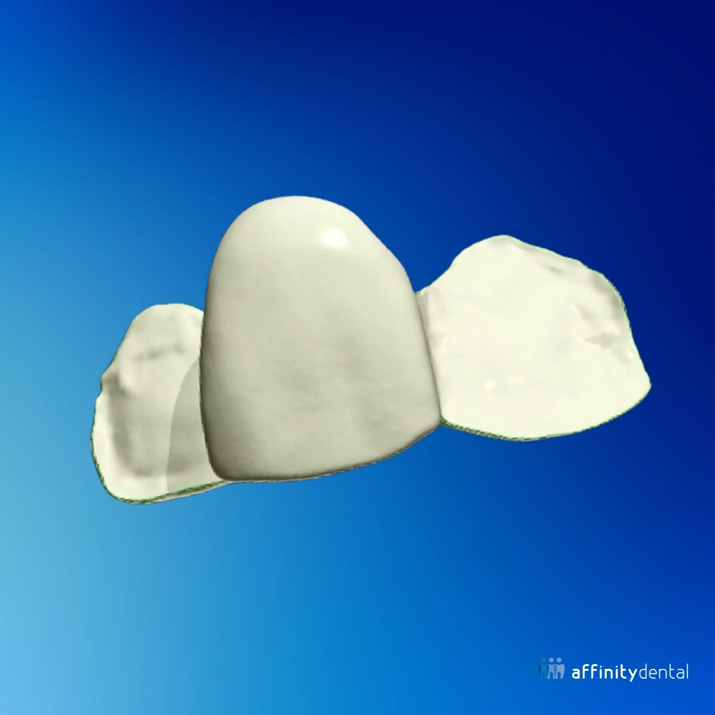 3D CAD/CAM digital design of a Maryland Bridge created at Affinity Dental Clinics Digital Laboratory