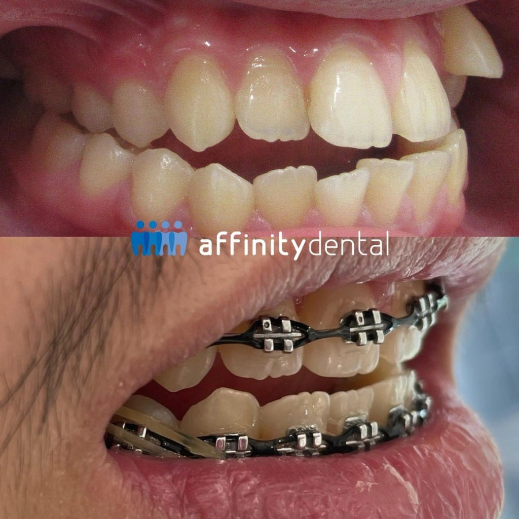 Side view of a patient with crowded teeth before treatment and in progress with metal braces at Affinity Dental Clinics
