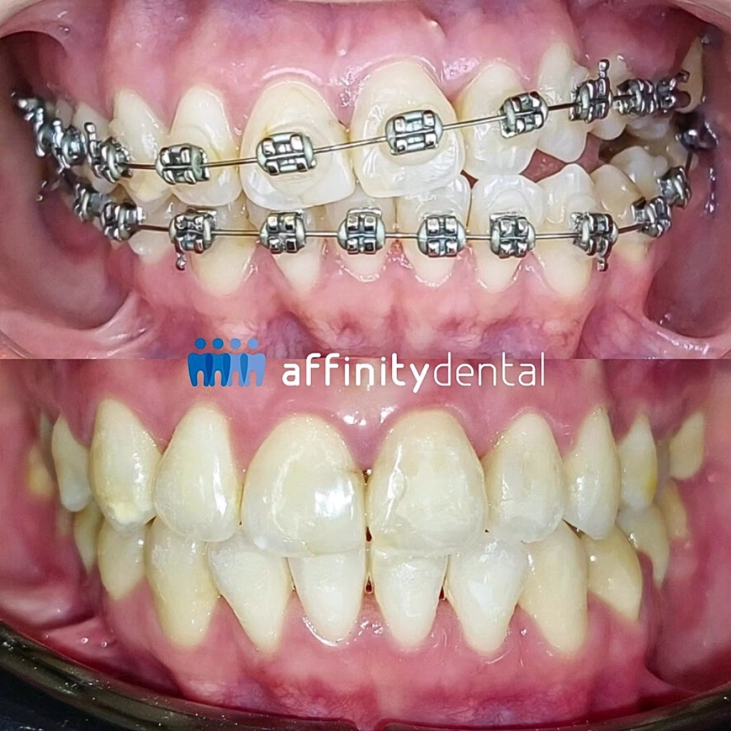 Before-and-after clinical photos of crowded and misaligned teeth corrected with traditional metal braces at Affinity Dental Clinics Makati