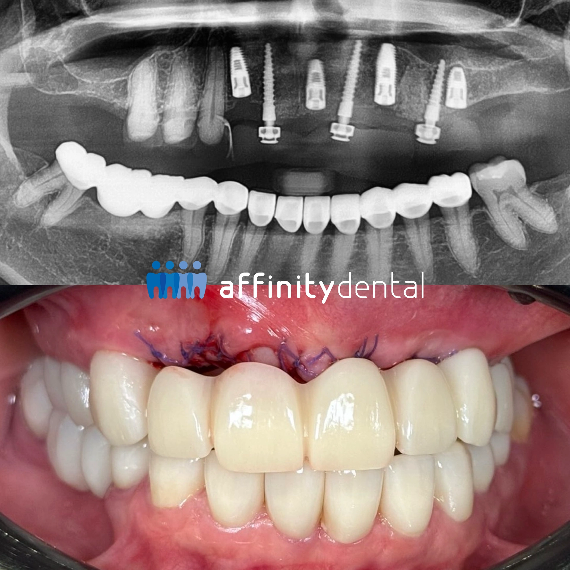X-ray and clinical photo showing mini dental implants supporting a temporary PMMA bridge alongside conventional implants at Affinity Dental Clinics