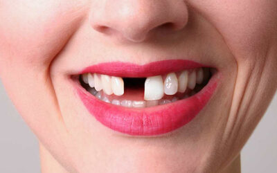 What are the Consequences of Missing Teeth?