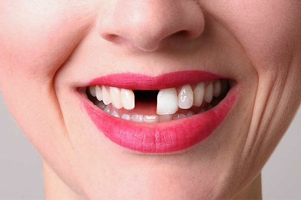 What are the Consequences of Missing Teeth?