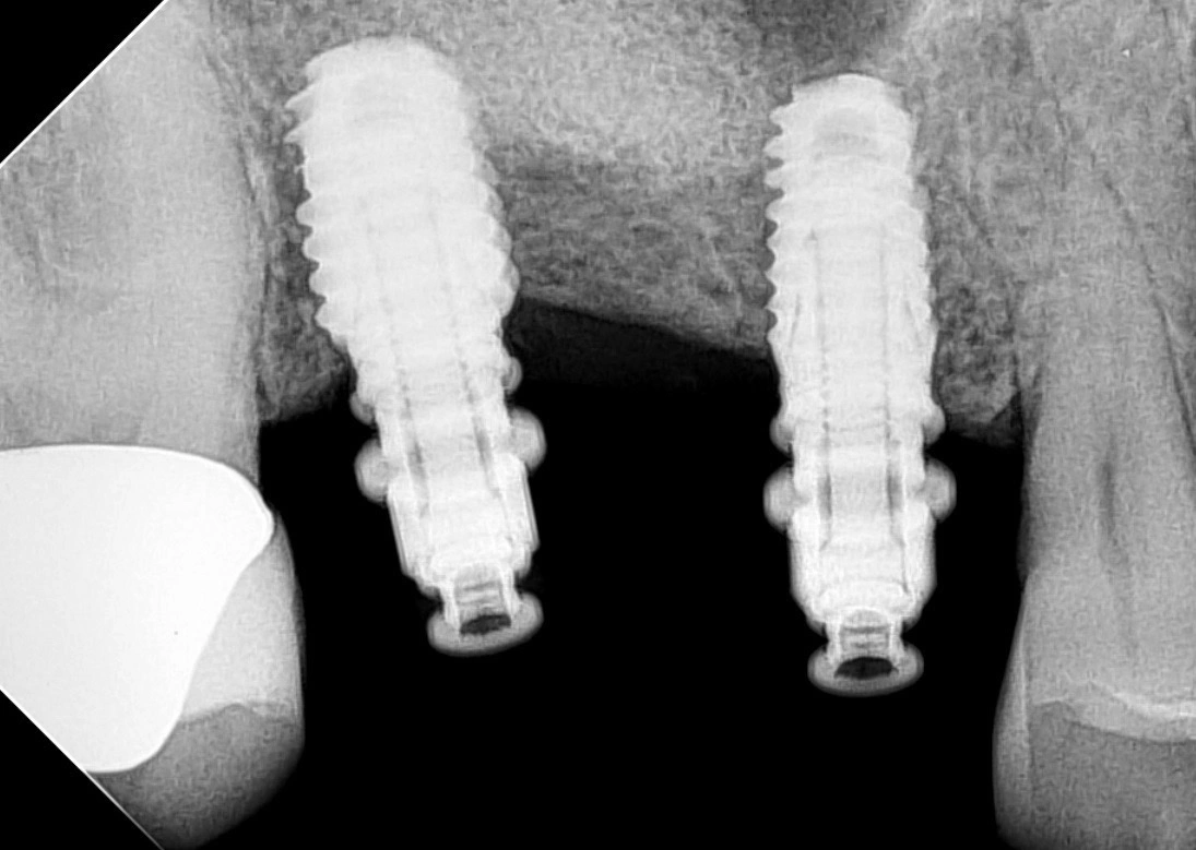 Dental X-ray showing two multiple dental implants securely placed at Affinity Dental Clinics.