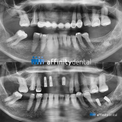 Panoramic X-ray showing before and after placement of multiple dental implants at Affinity Dental Clinics