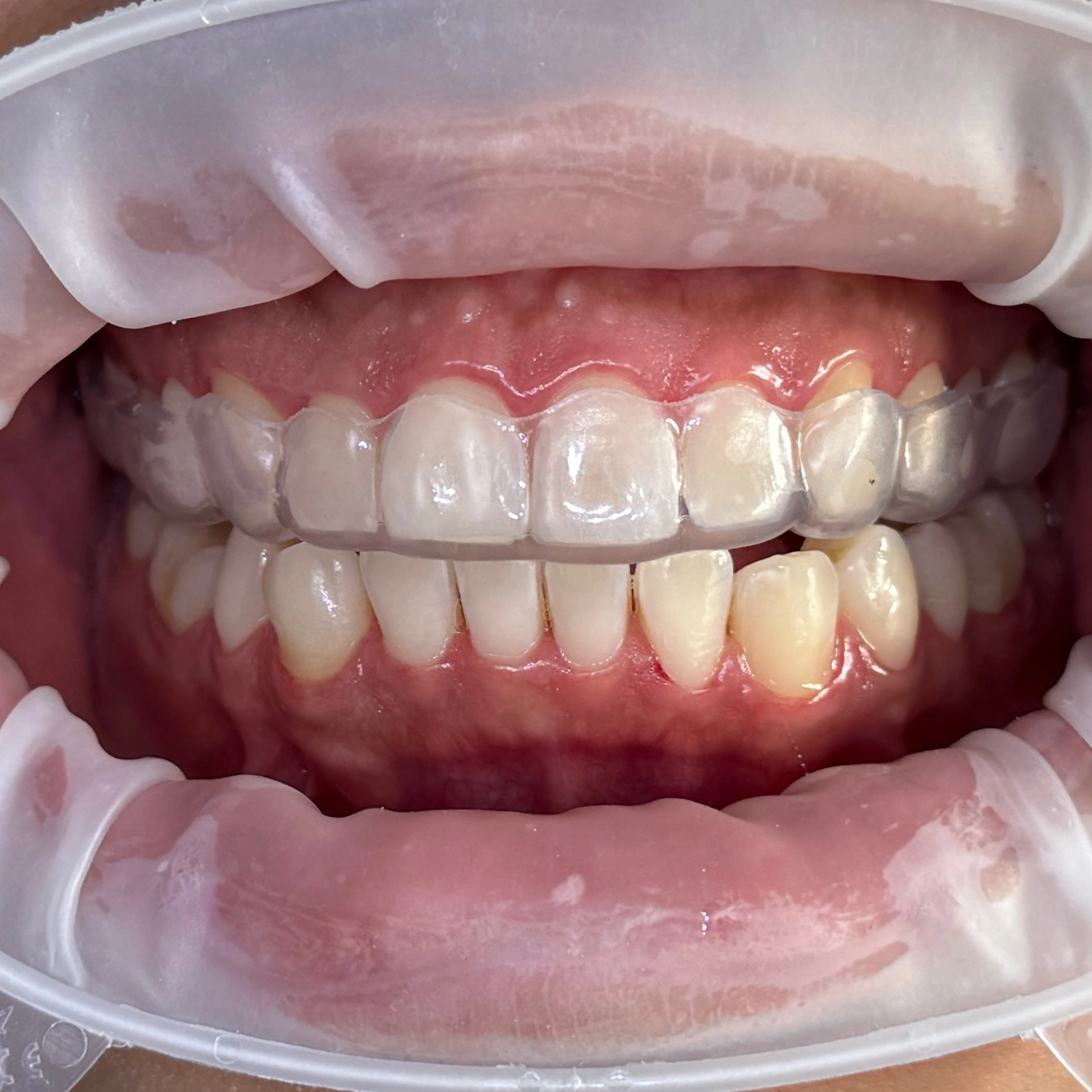 Patient wearing a custom-fitted clear nightguard for teeth grinding at Affinity Dental Clinics Makati