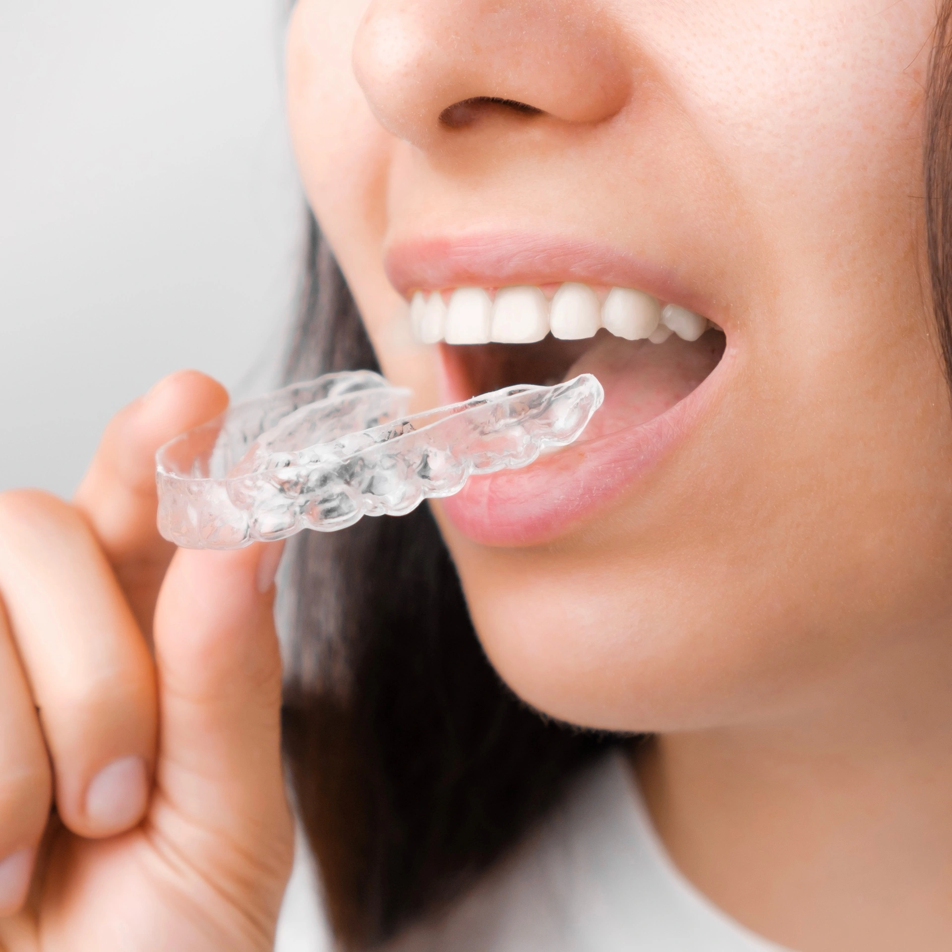 Close-up of a woman placing a clear night guard over her teeth for protection against grinding.