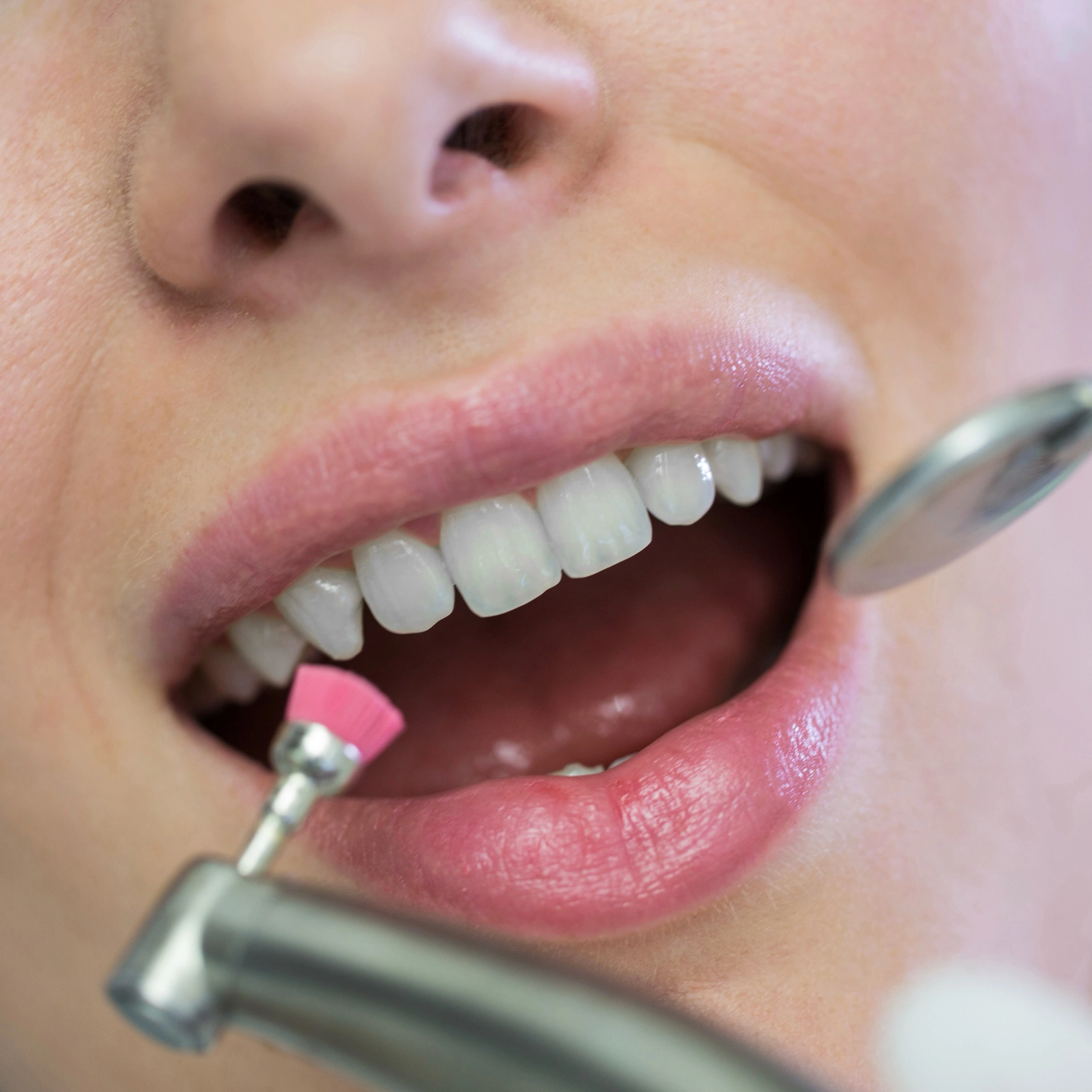 Close-up of a patient undergoing professional dental cleaning with a polishing brush and mirror.