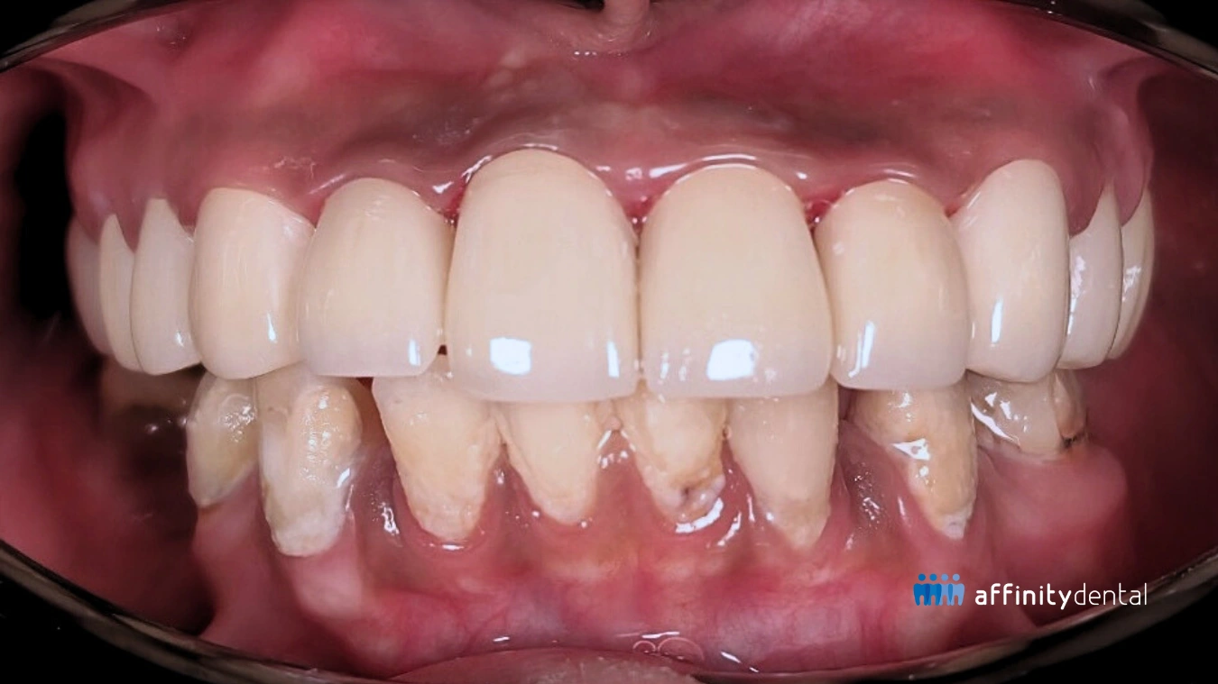 Close-up of restored upper teeth with zirconia crowns and PFZ bridge after braces done wrong caused decay and necrosis.
