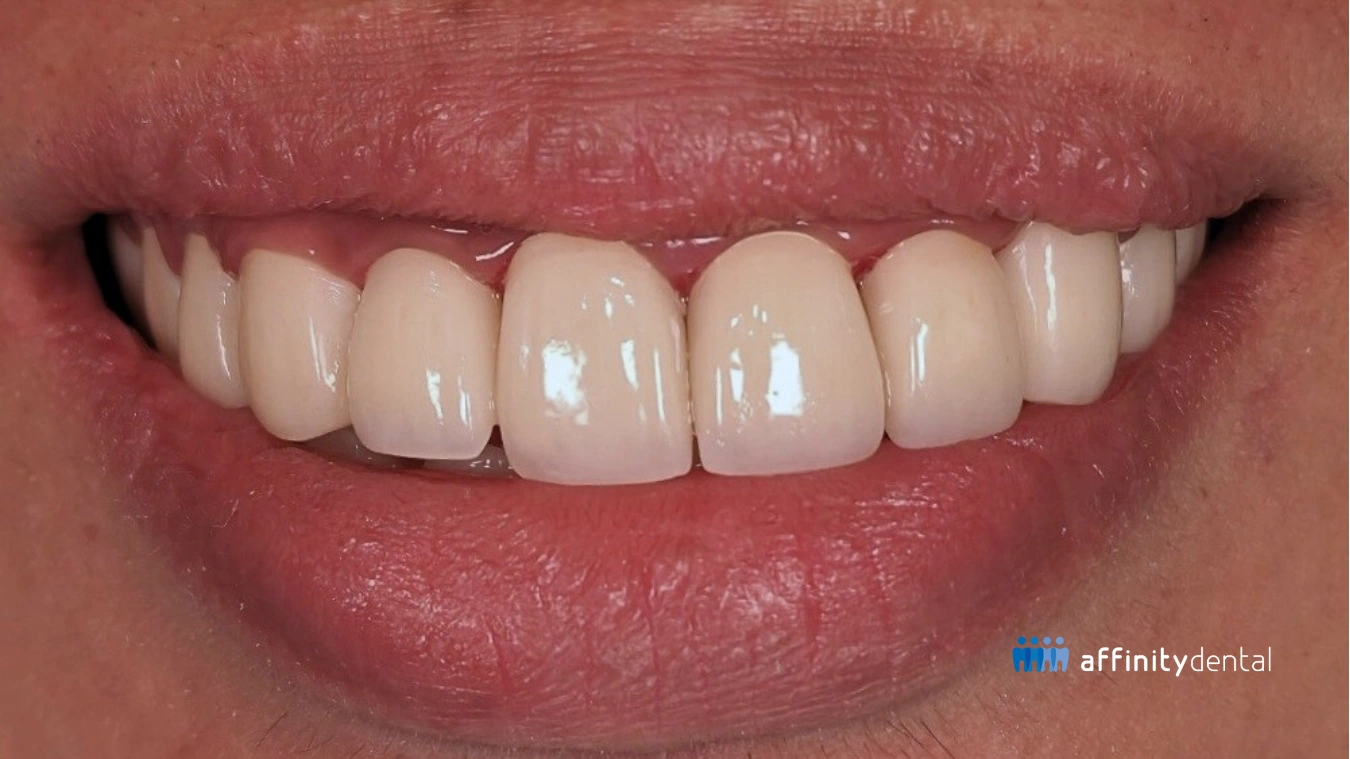 Close-up of restored smile with zirconia crowns after braces done wrong caused severe decay and necrosis.