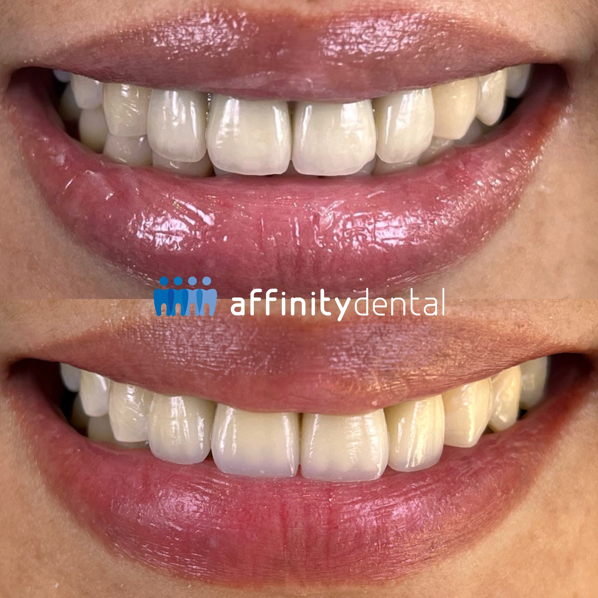Before-and-after smile comparing an old PFM bridge with dark margins and a new zirconia bridge at Affinity Dental Clinics Makati