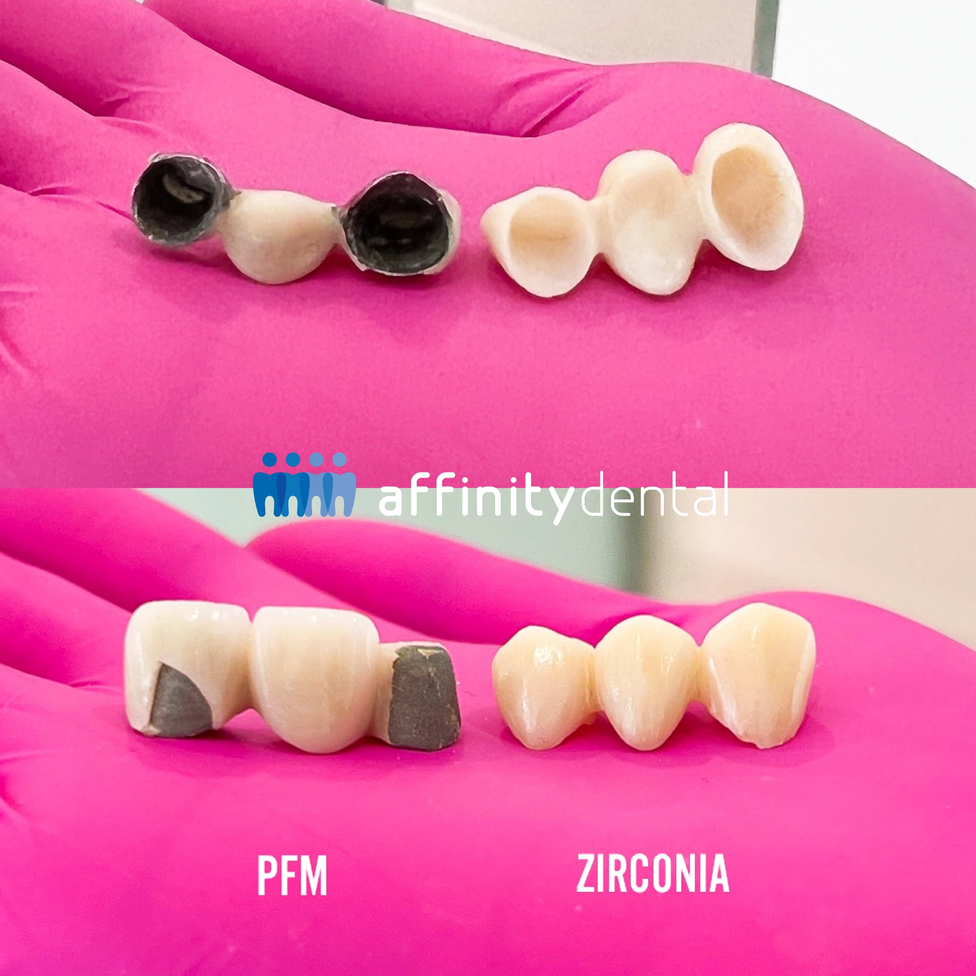 Side-by-side comparison of a Porcelain-Fused-to-Metal (PFM) bridge and a Zirconia bridge at Affinity Dental Clinics, showing metal base versus all-ceramic structure.