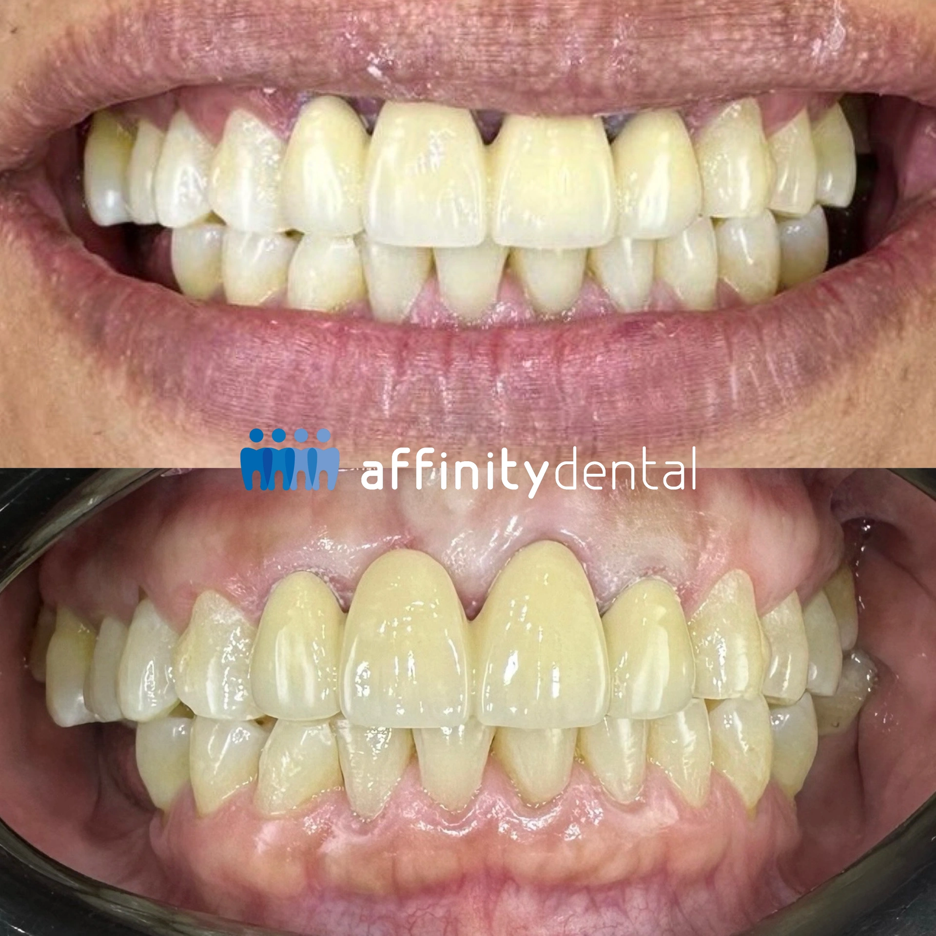 Before-and-after photos showing replacement of an old PFM bridge with dark margins by a new PFM bridge at Affinity Dental Clinics BGC Stopover