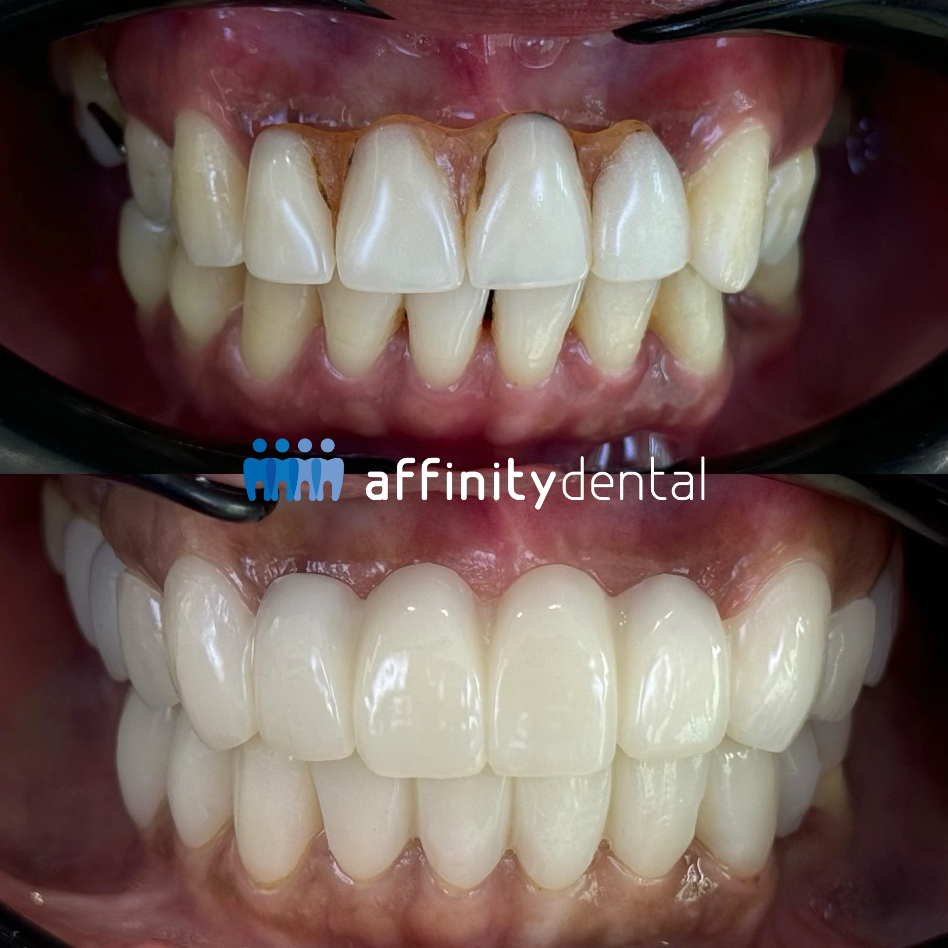 Before-and-after photos showing provisional Full Mouth PMMA bridges and crowns placed while dental implants are healing, before final zirconia bridges and crowns at Affinity Dental Clinics Makati