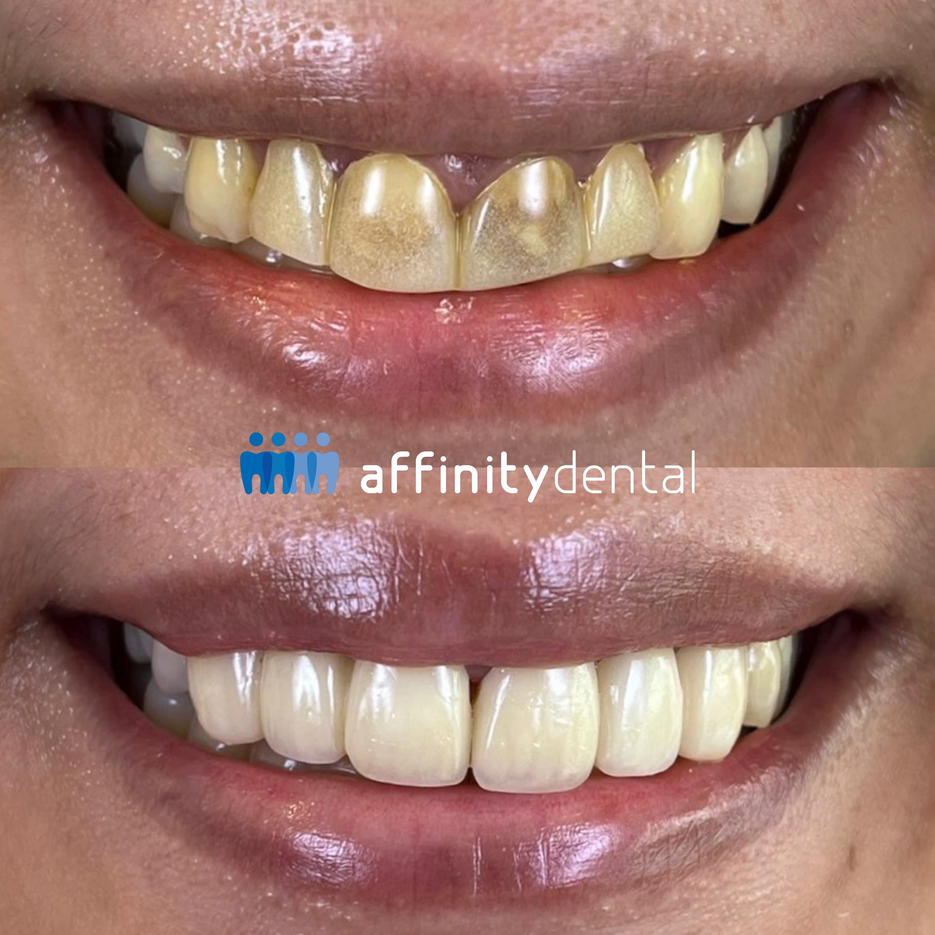 Before-and-after smile showing old PMMA restorations replaced with full porcelain crowns at Affinity Dental Clinics Makat