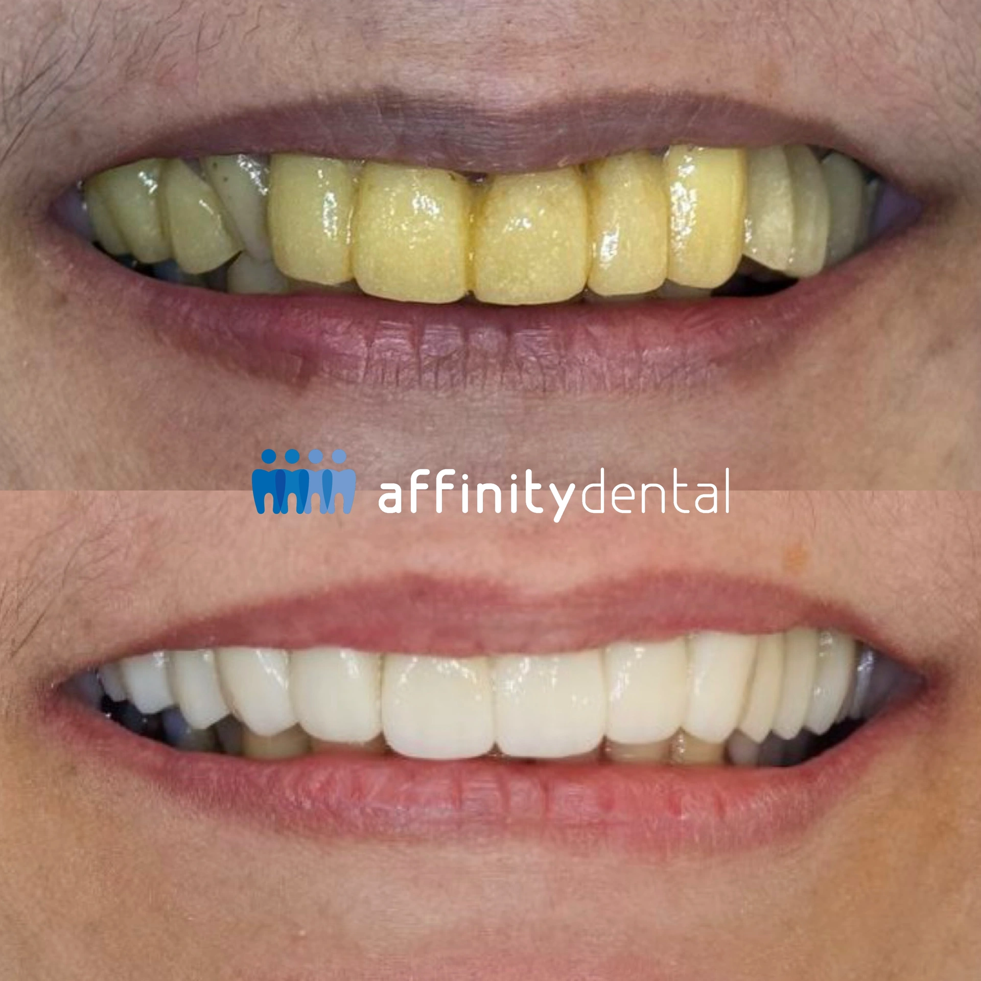 Replacing bulky discolored dental crowns and bridge with zirconia – Affinity Dental Clinics Philippines before and after