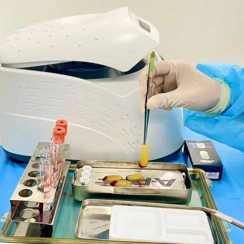 A gloved hand holding platelet-rich fibrin (PRF) with surgical tweezers beside a centrifuge and stainless steel trays in a dental surgery setup.