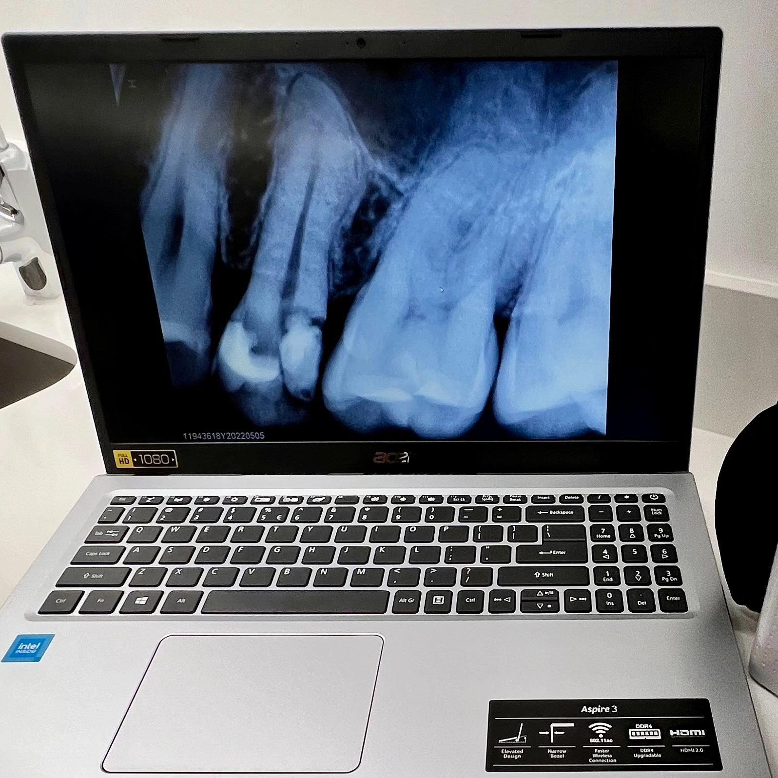 Digital periapical dental X-ray displayed on a laptop at Affinity Dental Clinics for instant and accurate diagnosis.
