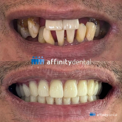 Before-and-after dental case showing severe periodontitis treated with complete tooth extraction. After photo shows complete dentures as interim restoration before All-on-X dental implants.