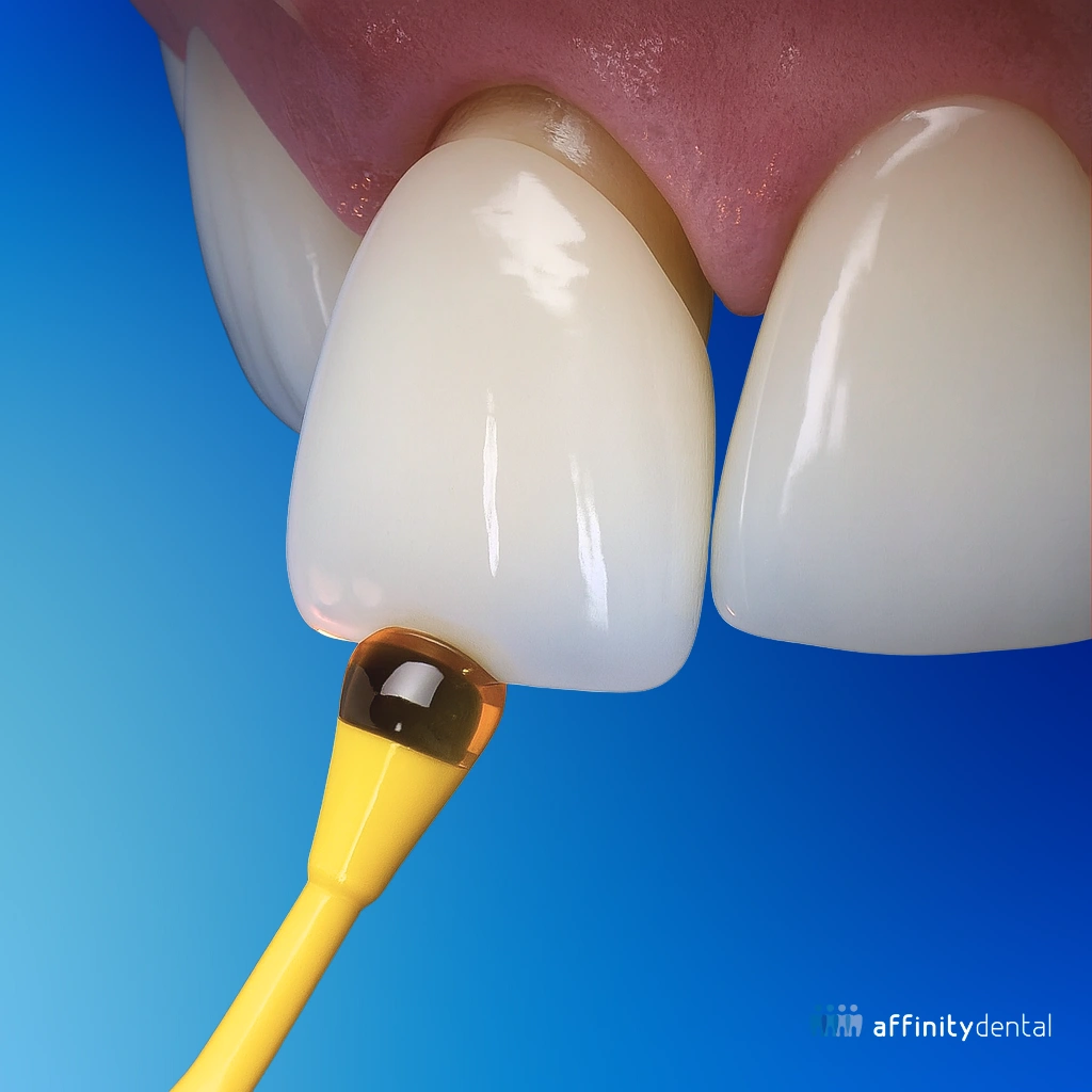 Close-up of porcelain crown preparation and bonding process on anterior tooth.