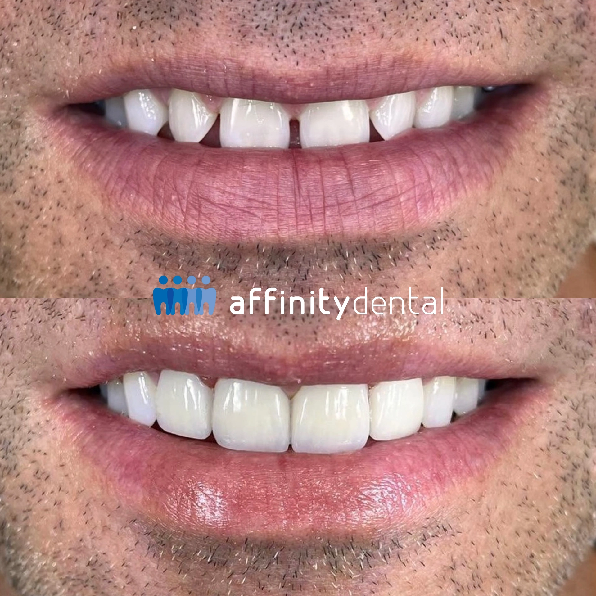 Before-and-after smile showing restoration with full EMAX porcelain crowns at Affinity Dental Clinics Makati