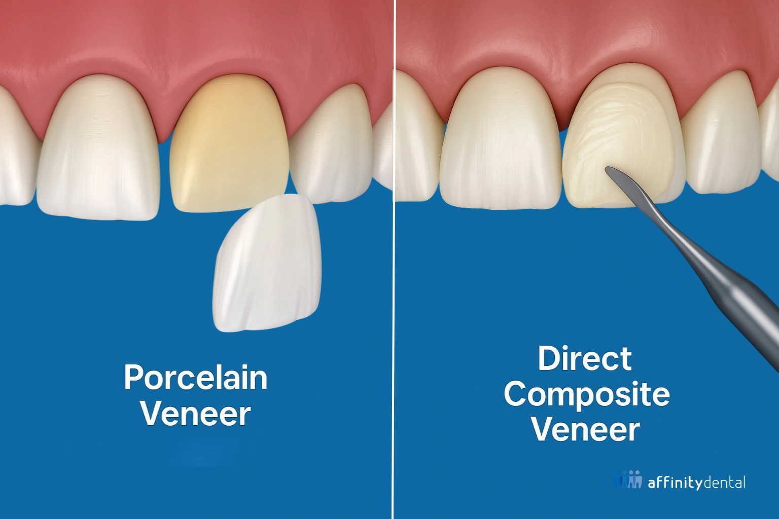 Illustration comparing porcelain veneer and direct composite veneer application on front teeth