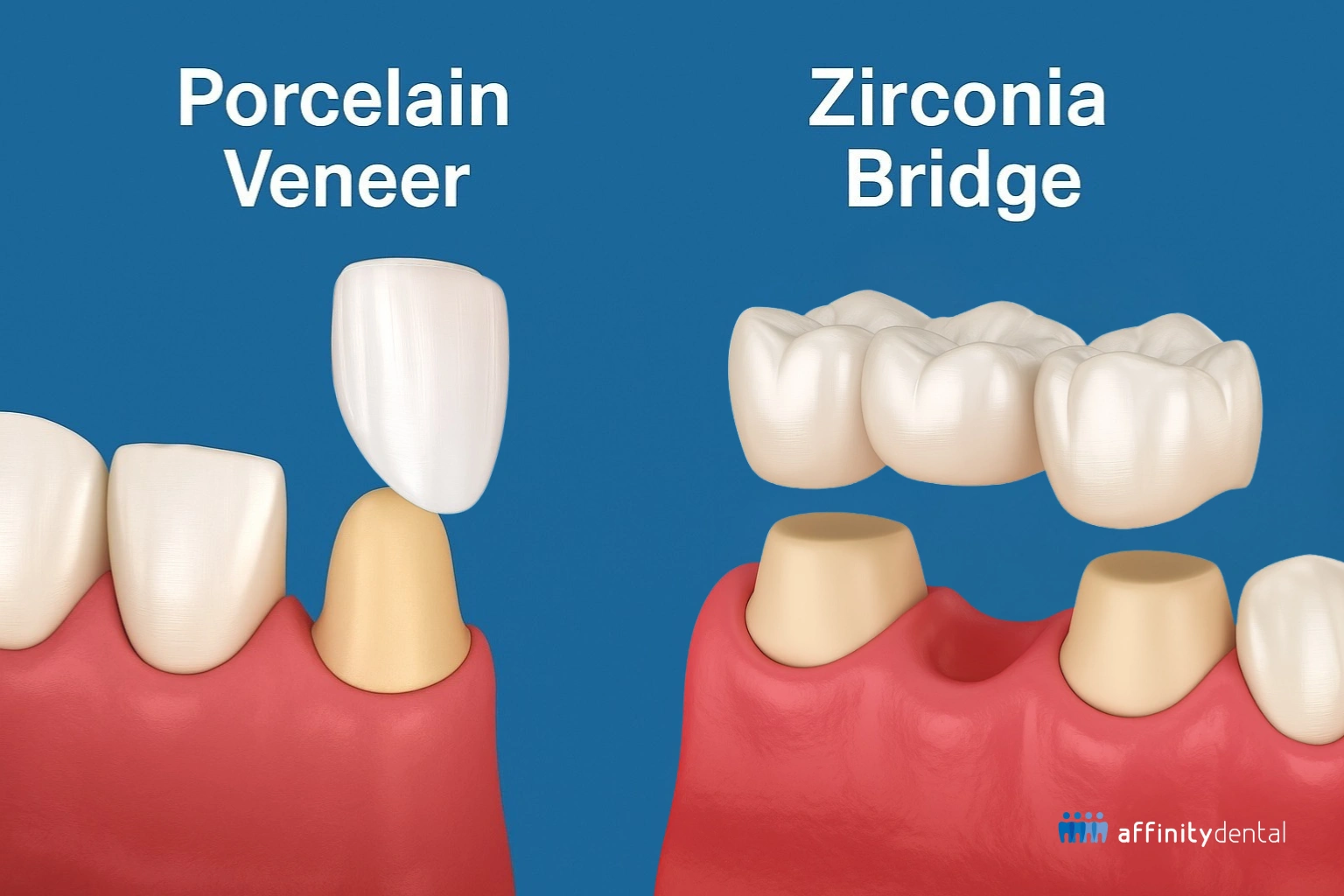 Dental illustration comparing porcelain veneer on a single tooth and zirconia bridge for multiple missing teeth