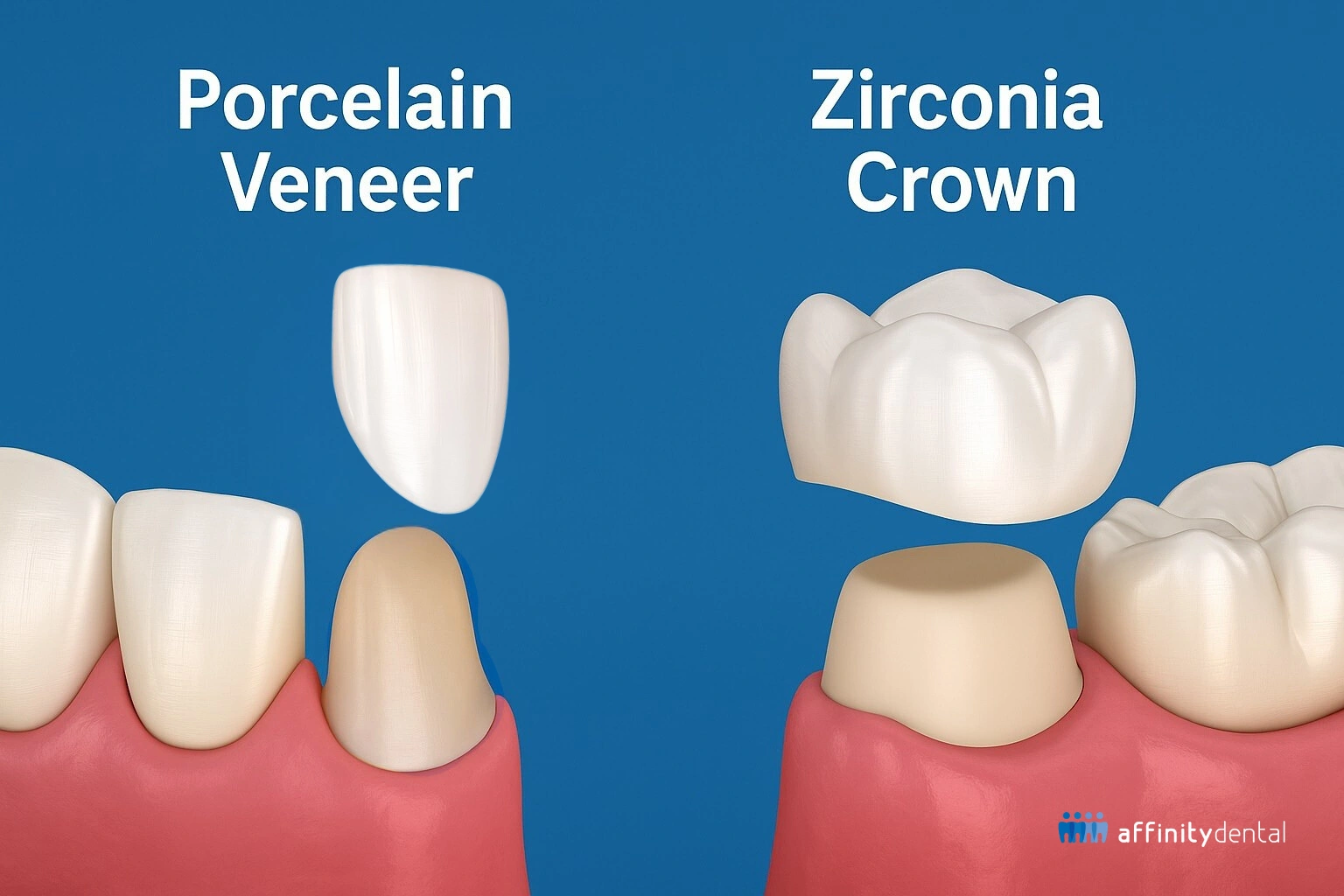 Illustration comparing porcelain veneer and zirconia crown placement on teeth