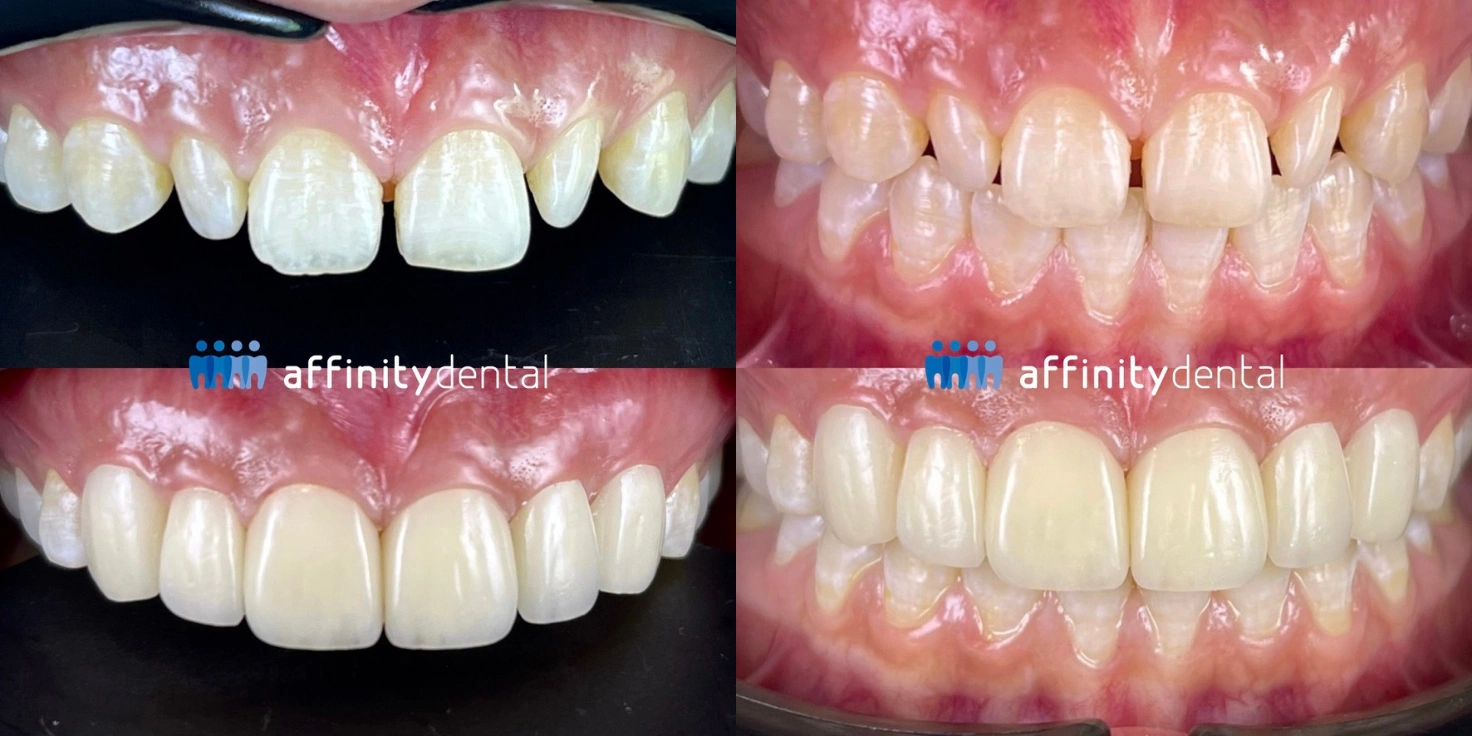 Before and after collage of porcelain veneers on upper front teeth (canines and incisors) showing improved color, shape, and alignment at Affinity Dental Clinics
