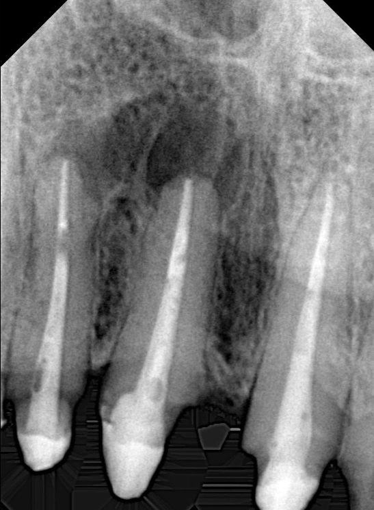 Dental X-ray showing multiple previously root canal treated teeth with signs of infection and failure requiring retreatment