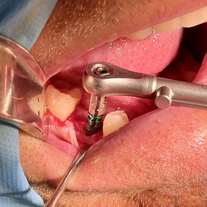 Close-up of a single dental implant placement during oral surgery at Affinity Dental Clinics.