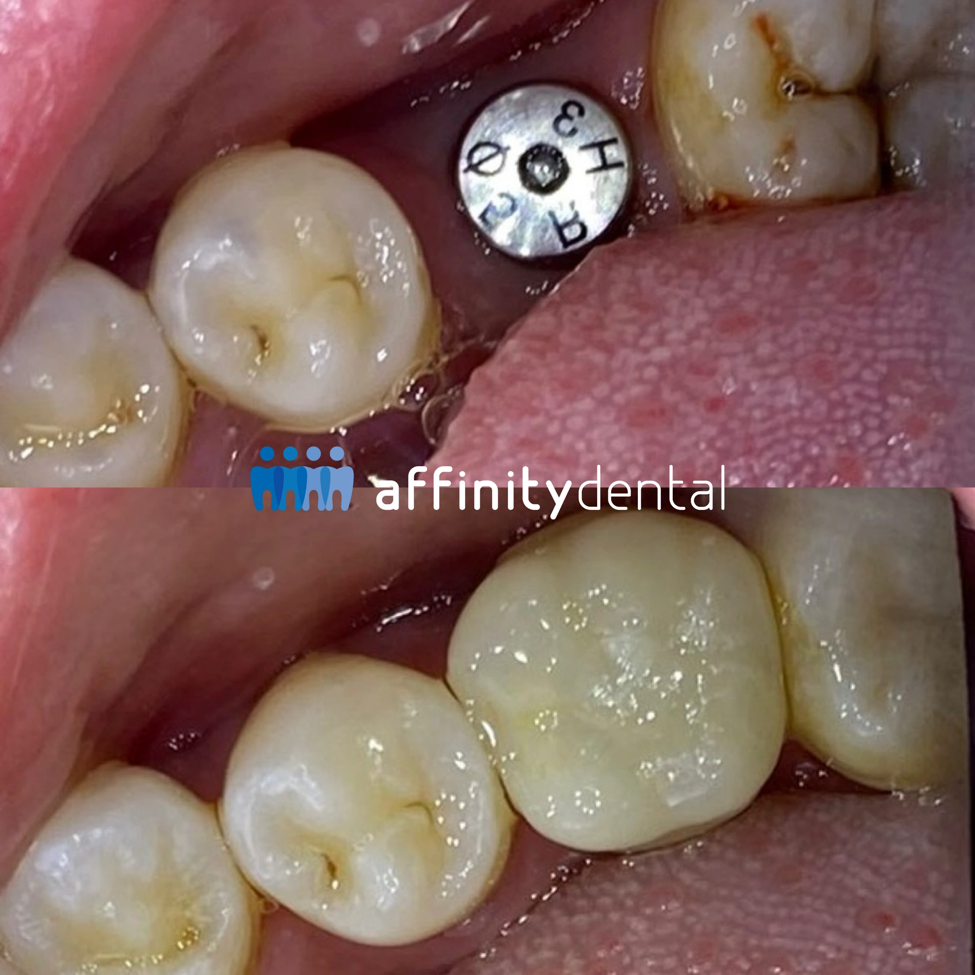 Close-up dental photo showing a single molar dental implant placement and final crown restoration at Affinity Dental Clinics