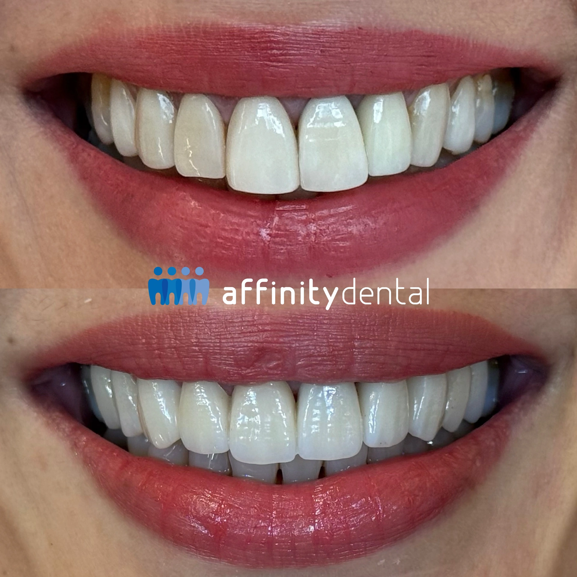 Before and after smile makeover replacing old chipped veneers with porcelain fused to zirconia crowns at Affinity Dental Clinics
