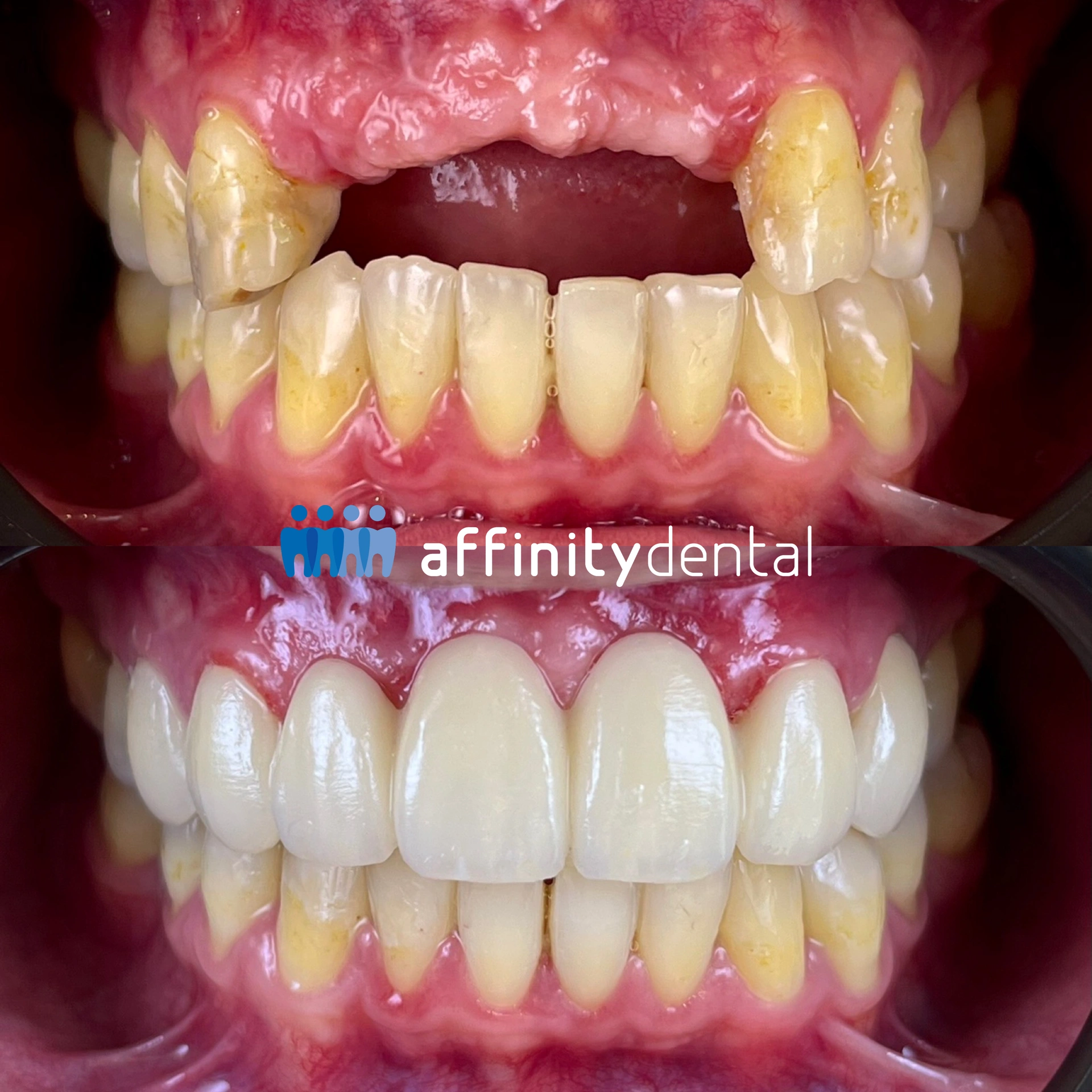 Before and after smile makeover with Zirconia dental bridge and crowns at Affinity Dental Clinics