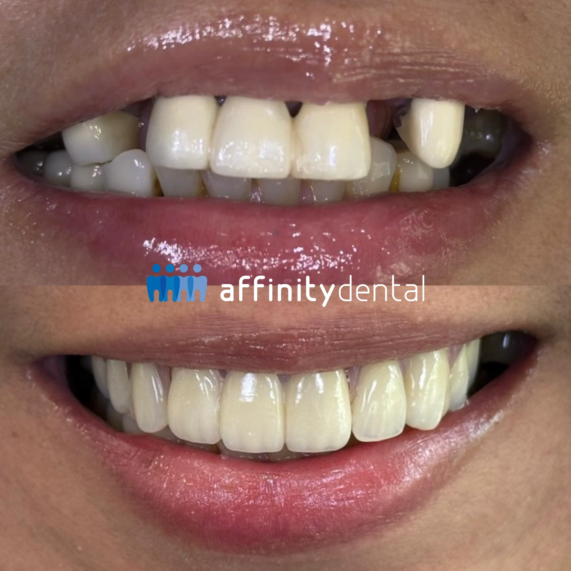 Before and after smile makeover using zirconia bridge, crowns, and denture at Affinity Dental Clinics Makati