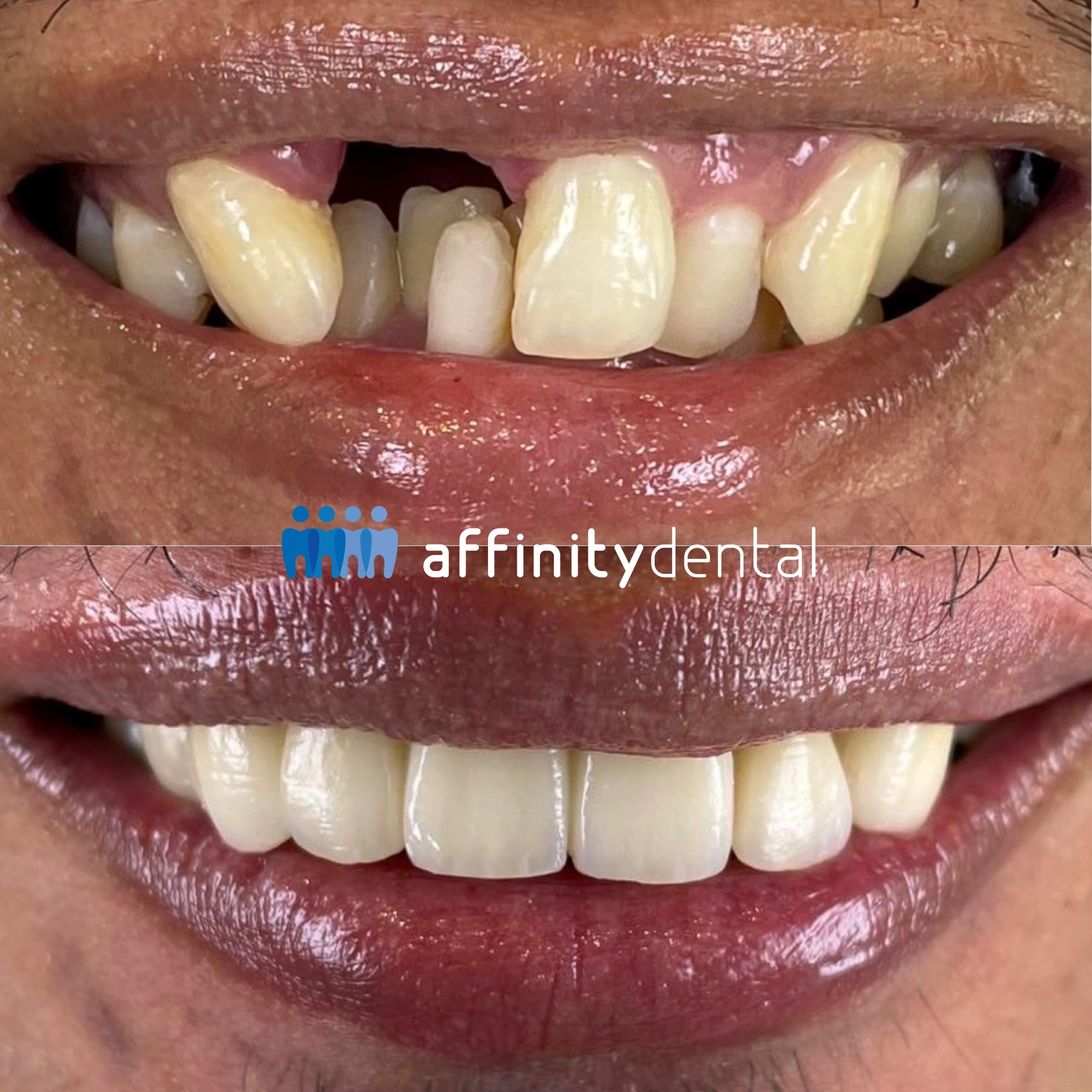 Before and after smile makeover with zirconia bridge and crowns at Affinity Dental Clinics Makati