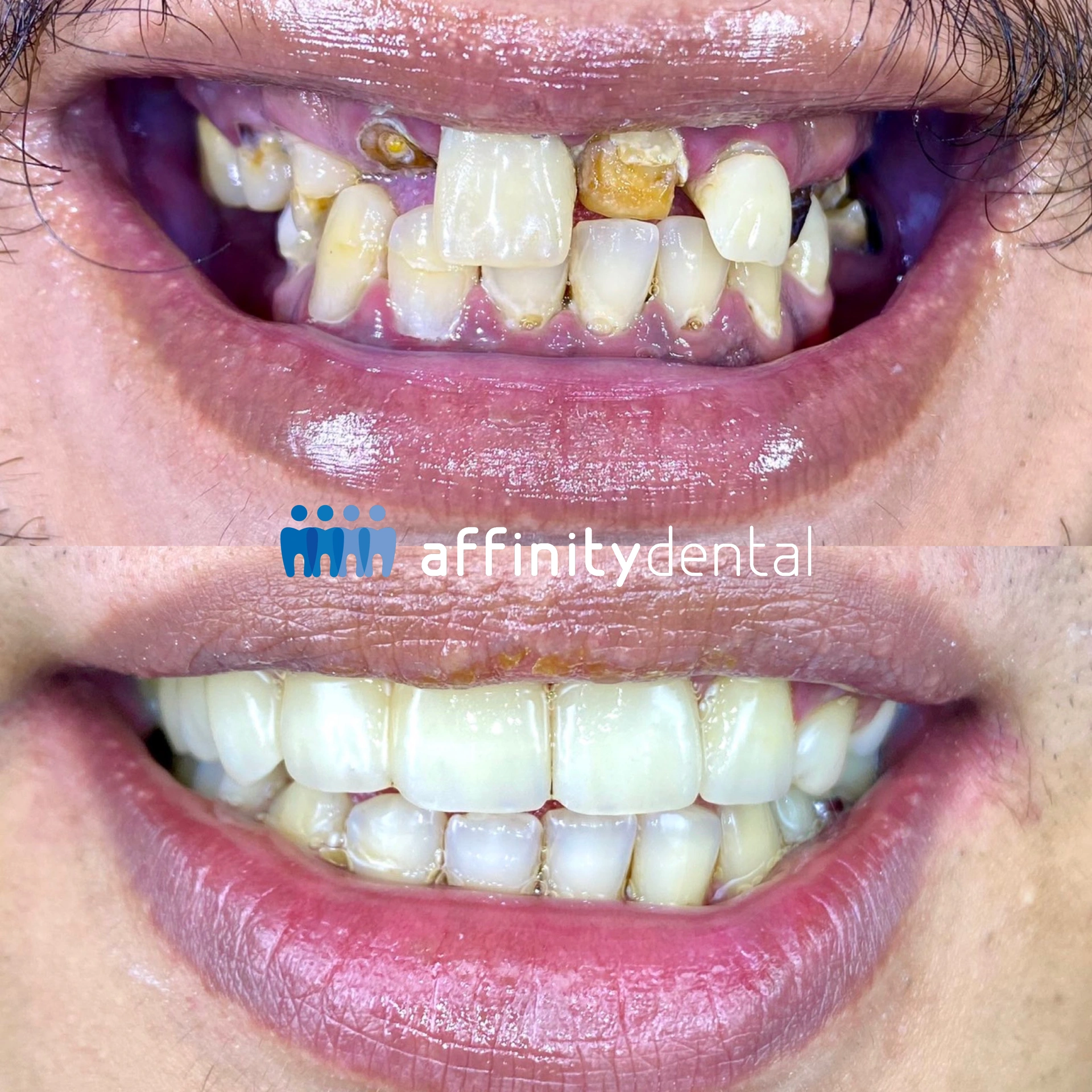 Before and after smile makeover with zirconia bridge, crowns, root canal treatments, and extractions at Affinity Dental Clinics BGC Stopover